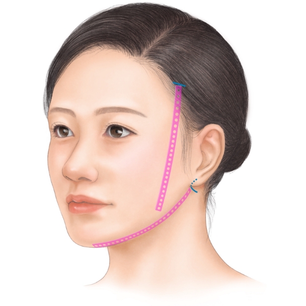 挿入できる部位