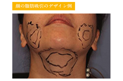 東京・渋谷の宮益坂クリニックの顔の脂肪吸引のポイント