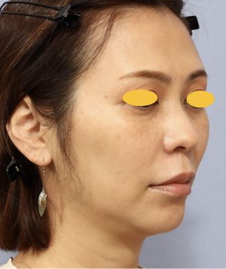 宮益坂クリニックのFAT FACE peptideの症例写真と経過①（術前）