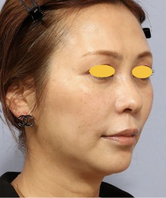 宮益坂クリニックのFAT FACE peptideの症例写真と経過①（術後）