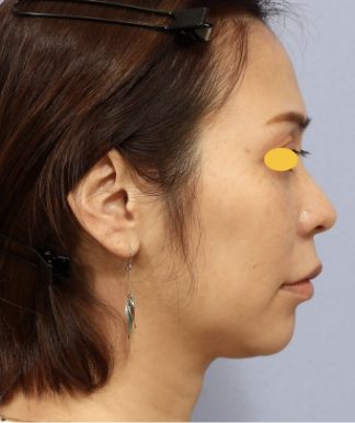 宮益坂クリニックのFAT FACE peptideの症例写真と経過①（術前）