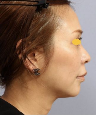 宮益坂クリニックのFAT FACE peptideの症例写真と経過①（術後）