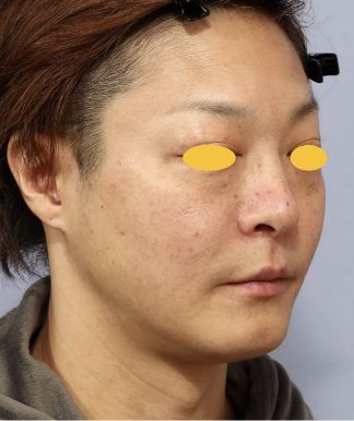 宮益坂クリニックのFAT FACE peptideの症例写真と経過②（術前）