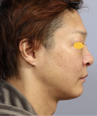 宮益坂クリニックのFAT FACE peptideの症例写真と経過②（術前）