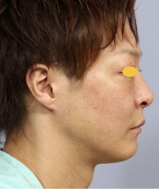 宮益坂クリニックのFAT FACE peptideの症例写真と経過②（術後）