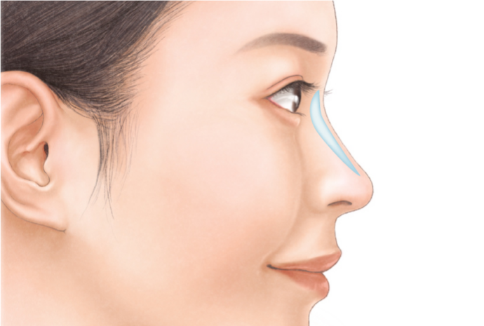 宮益坂クリニックの鼻のプロテーゼ挿入の治療のポイント