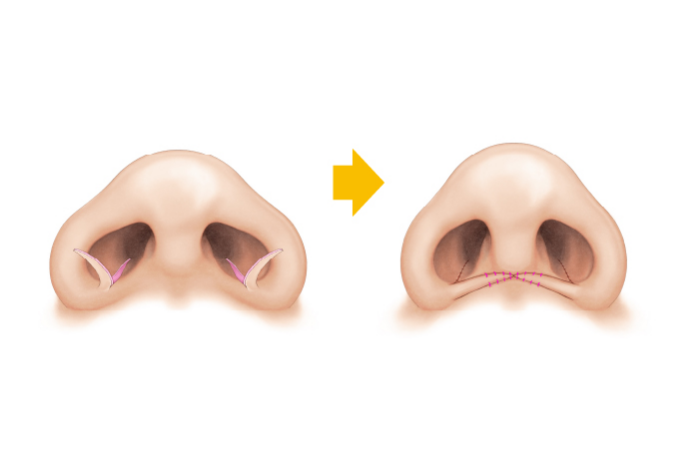 鼻翼縮小術の治療方法（フラップ法）