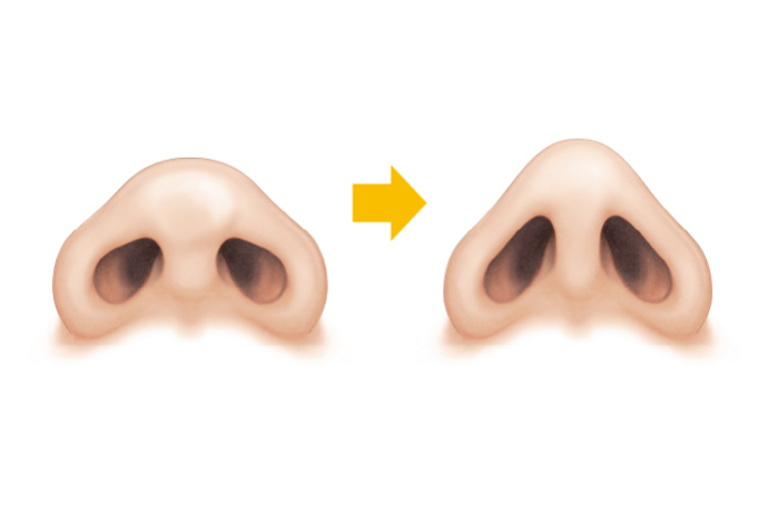 鼻尖縮小術・鼻尖形成術（だんご鼻の整形）の効果