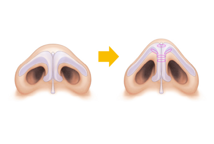 軟骨縫合による鼻尖形成術の治療方法