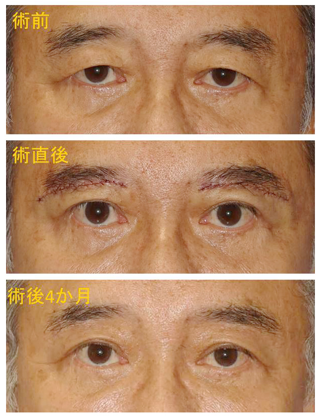 宮益坂クリニックの男性の眉毛下切開の症例写真