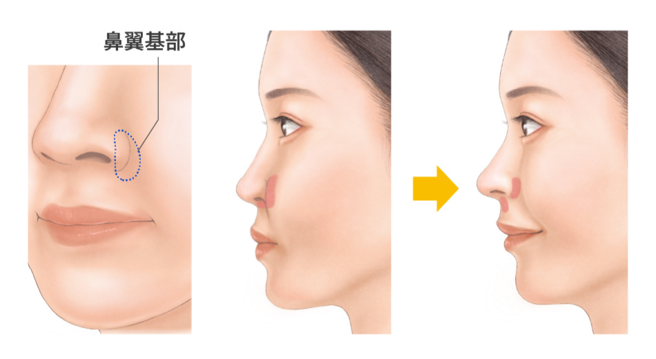 鼻翼基部プロテーゼの治療方法