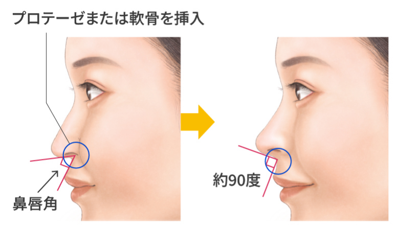 鼻翼基部の整形の効果