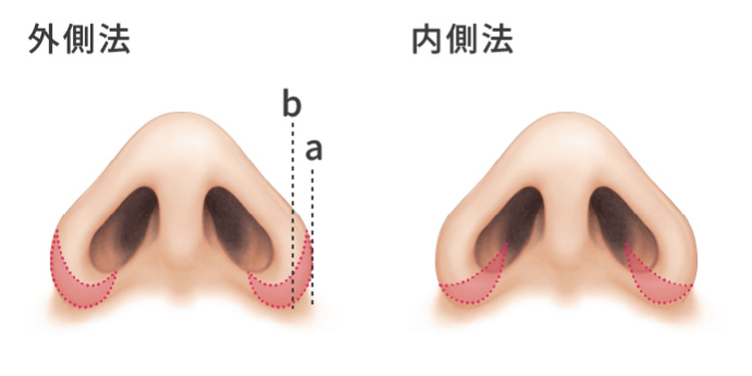 鼻翼縮小術の治療方法（外側法・内側法）