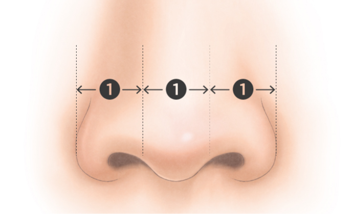 鼻翼縮小術の治療のポイント