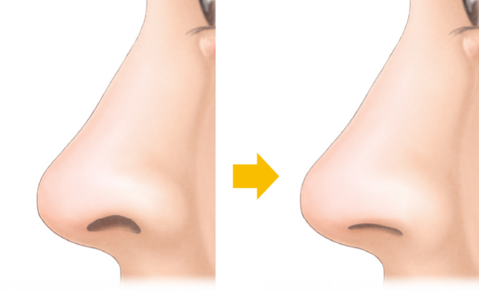 鼻柱挙上術の効果
