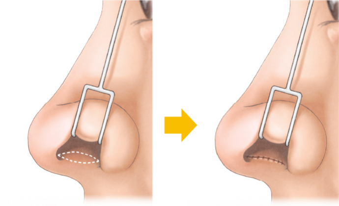鼻柱挙上術の治療方法