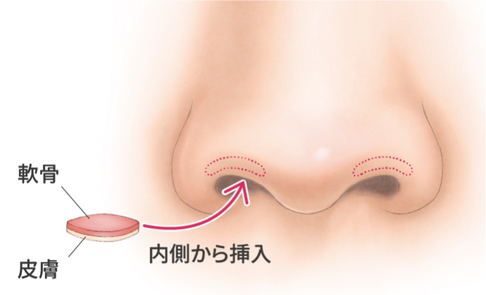 鼻孔縁下降術の治療方法