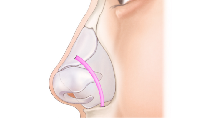 宮益坂クリニックの鼻翼挙上（筋膜移植）の治療方法