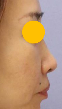 宮益坂クリニックの鼻翼基部のヒアルロン酸注入の症例写真（術前）