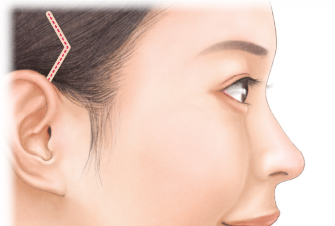 宮益坂クリニックの鼻のプロテーゼ挿入の治療方法
