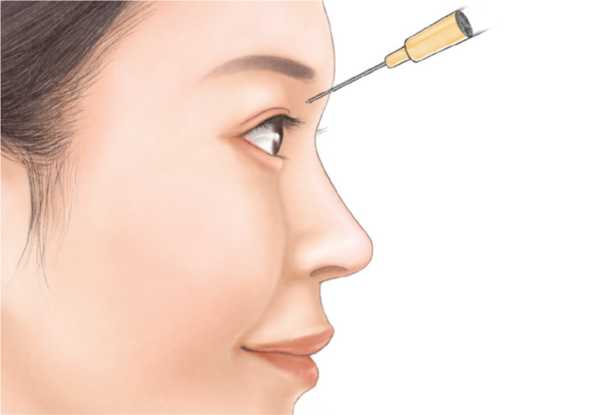 宮益坂クリニックの鼻のヒアルロン酸注射の効果
