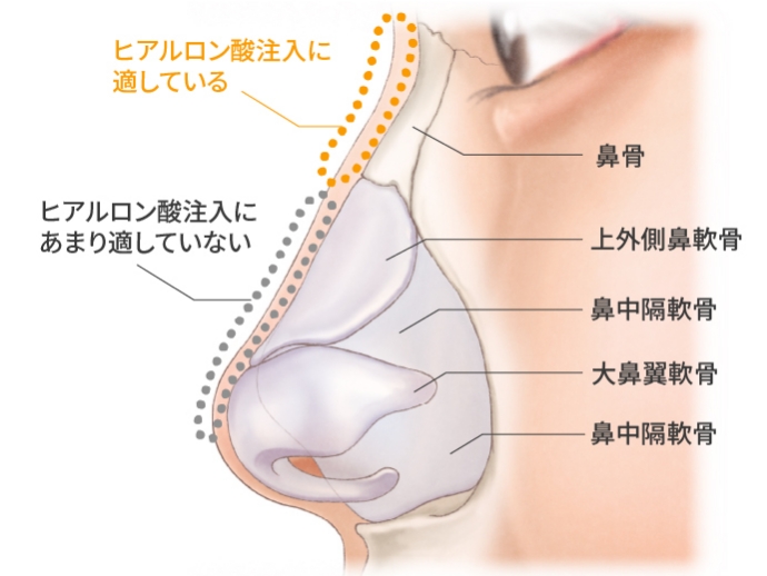 宮益坂クリニックの鼻のヒアルロン酸注射のポイント