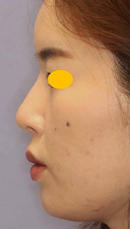プロテーゼ挿入＋鼻先の整形の症例写真（術後）
