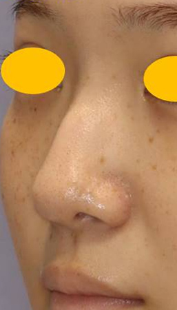 宮益坂クリニックの細片軟骨移植（耳介軟骨）の症例写真