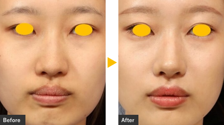 細片軟骨移植による鼻フル整形の症例写真