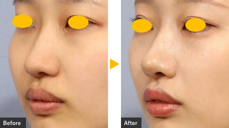 細片軟骨移植による鼻フル整形の症例写真