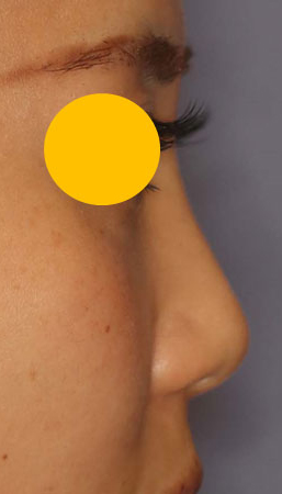 ヒアルロン酸注入による隆鼻術の症例写真（術前）