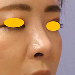 宮益坂クリニックの鼻尖形成術＋リムグラフトの症例写真①（術後）