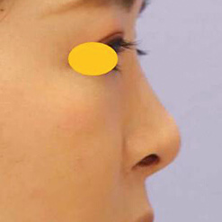 宮益坂クリニックの鼻尖形成術＋リムグラフトの症例写真②（術後）