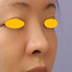 宮益坂クリニックの鼻尖形成術＋リムグラフトの症例写真①（術前）