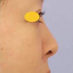 宮益坂クリニックの鼻尖形成術＋リムグラフトの症例写真②（術前）