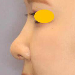 鼻尖形成術＋リムグラフトの症例写真②（術後）