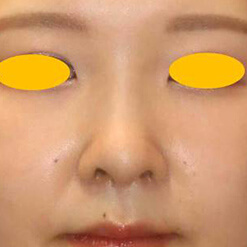 鼻尖形成術＋リムグラフトの症例写真②（術後）