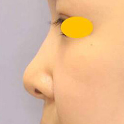 鼻尖形成術＋リムグラフトの症例写真②（術前）