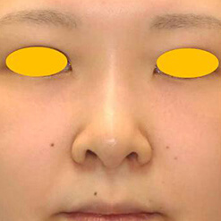 鼻尖形成術＋リムグラフトの症例写真②（術前）