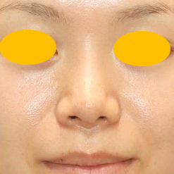 鼻尖形成＋鼻プロテーゼ挿入の症例写真（術後）