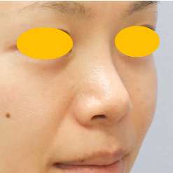 鼻尖形成＋鼻プロテーゼ挿入の症例写真（術後）