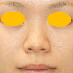 鼻尖形成＋鼻プロテーゼ挿入の症例写真（術前）