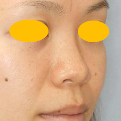 鼻尖形成＋鼻プロテーゼ挿入の症例写真（術前）