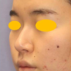 鼻中隔延長＋鼻尖縮小＋鼻尖軟骨移植＋隆鼻術の症例写真（術前）