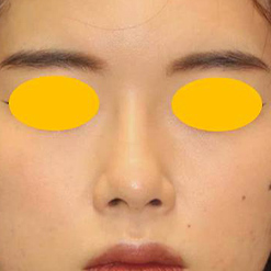 鼻中隔延長＋鼻尖縮小＋鼻尖軟骨移植＋隆鼻術の症例写真（術後）