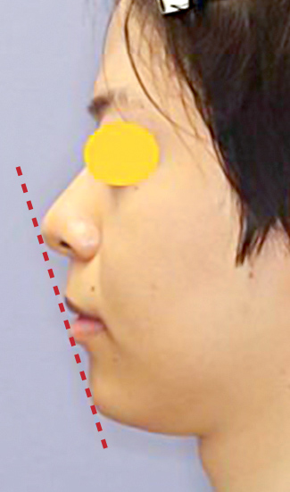 顎プロテーゼ挿入の症例写真（術後）