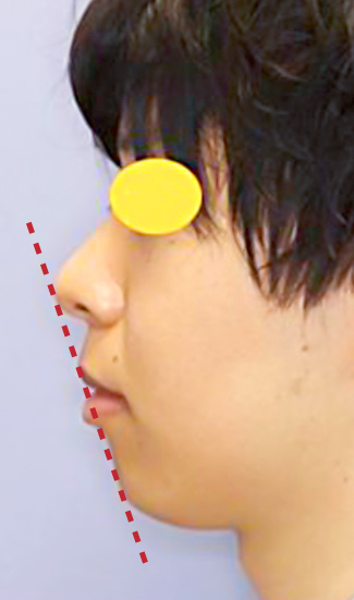 顎プロテーゼ挿入の症例写真（術前）