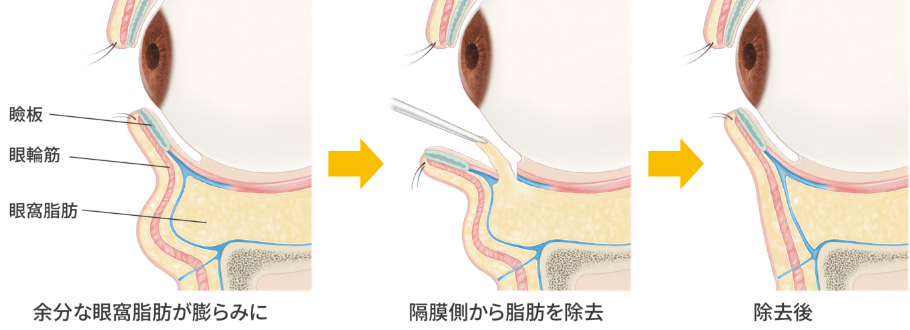 経結膜下眼瞼脱脂術（目の下の脂肪取り）